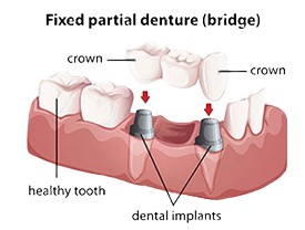 Dental Bridges | Kenneth Yates DDS | Beverly Hills, CA 90212