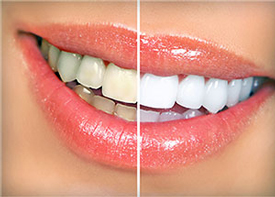Teeth Whitening | Kenneth Yates DDS | Beverly Hills, CA 90212